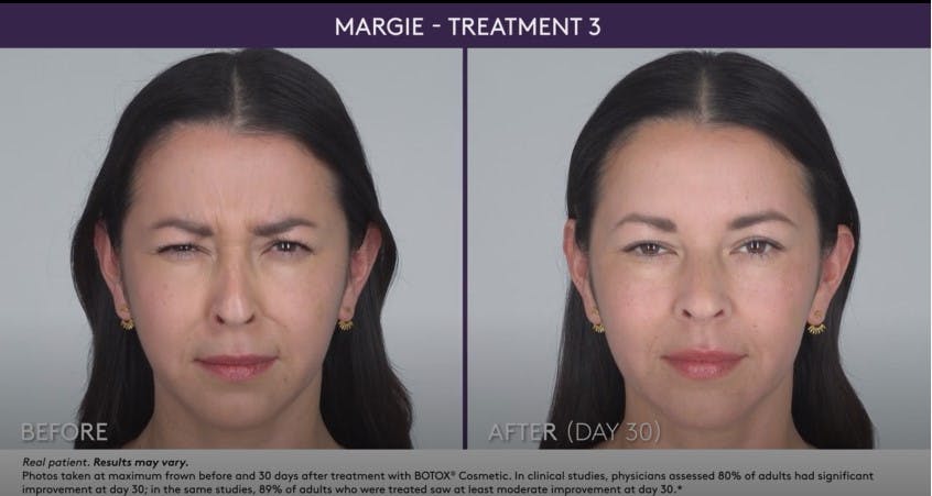 BOTOX Before & After Gallery - Patient 105702581 - Image 1