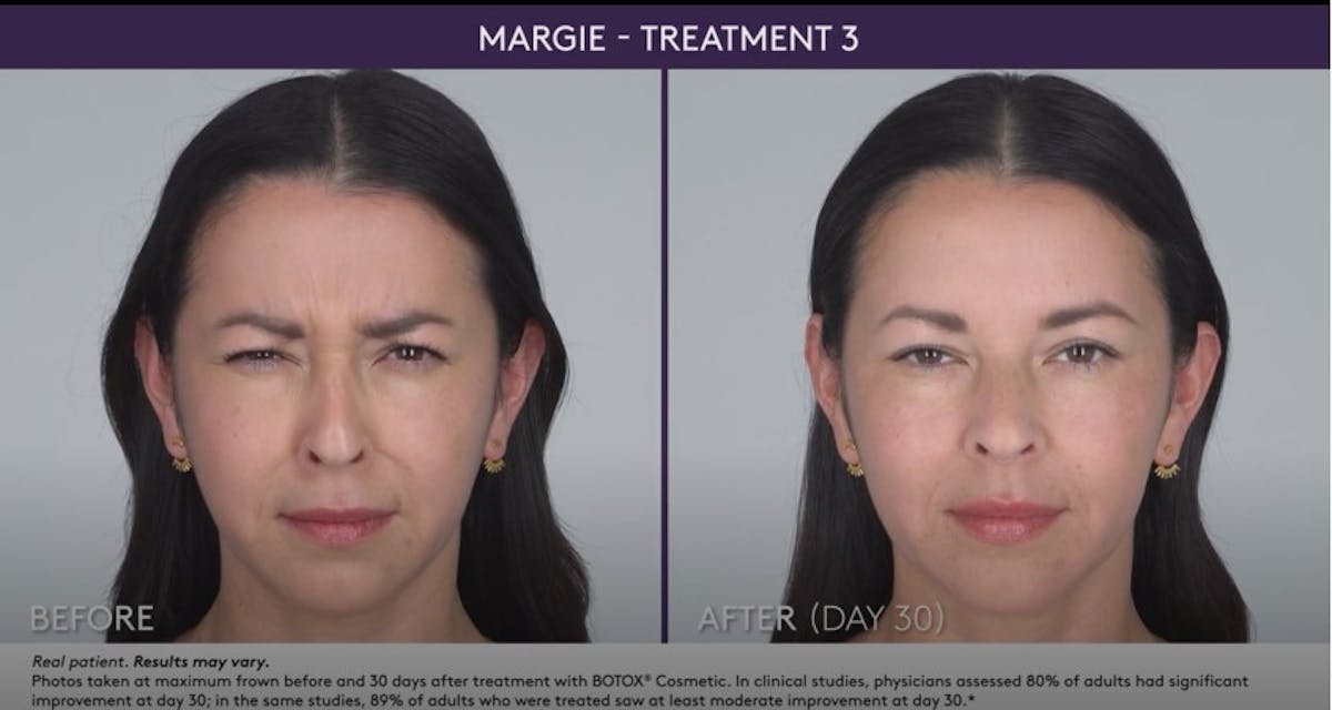 BOTOX Before & After Gallery - Patient 105702581 - Image 1