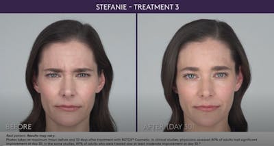 BOTOX Before & After Gallery - Patient 105702582 - Image 1