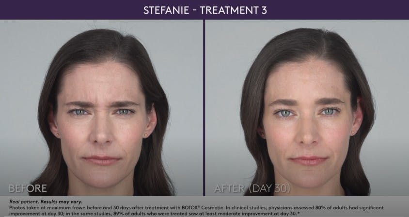 BOTOX Before & After Gallery - Patient 105702582 - Image 1