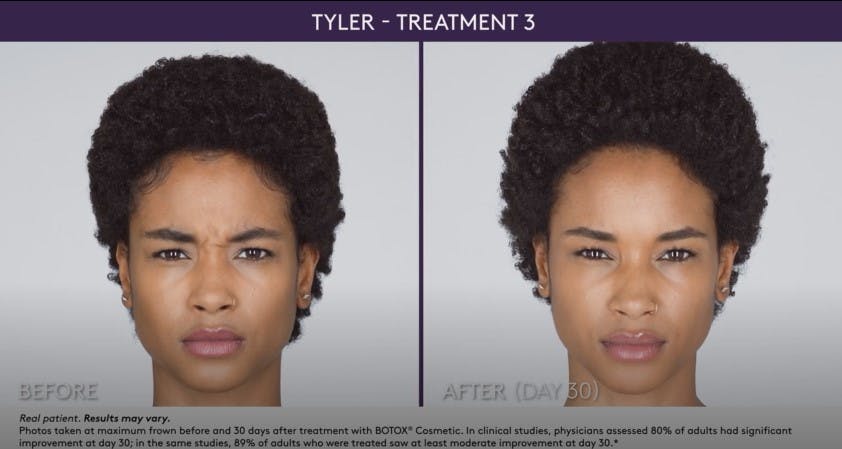 BOTOX Before & After Gallery - Patient 105702583 - Image 1