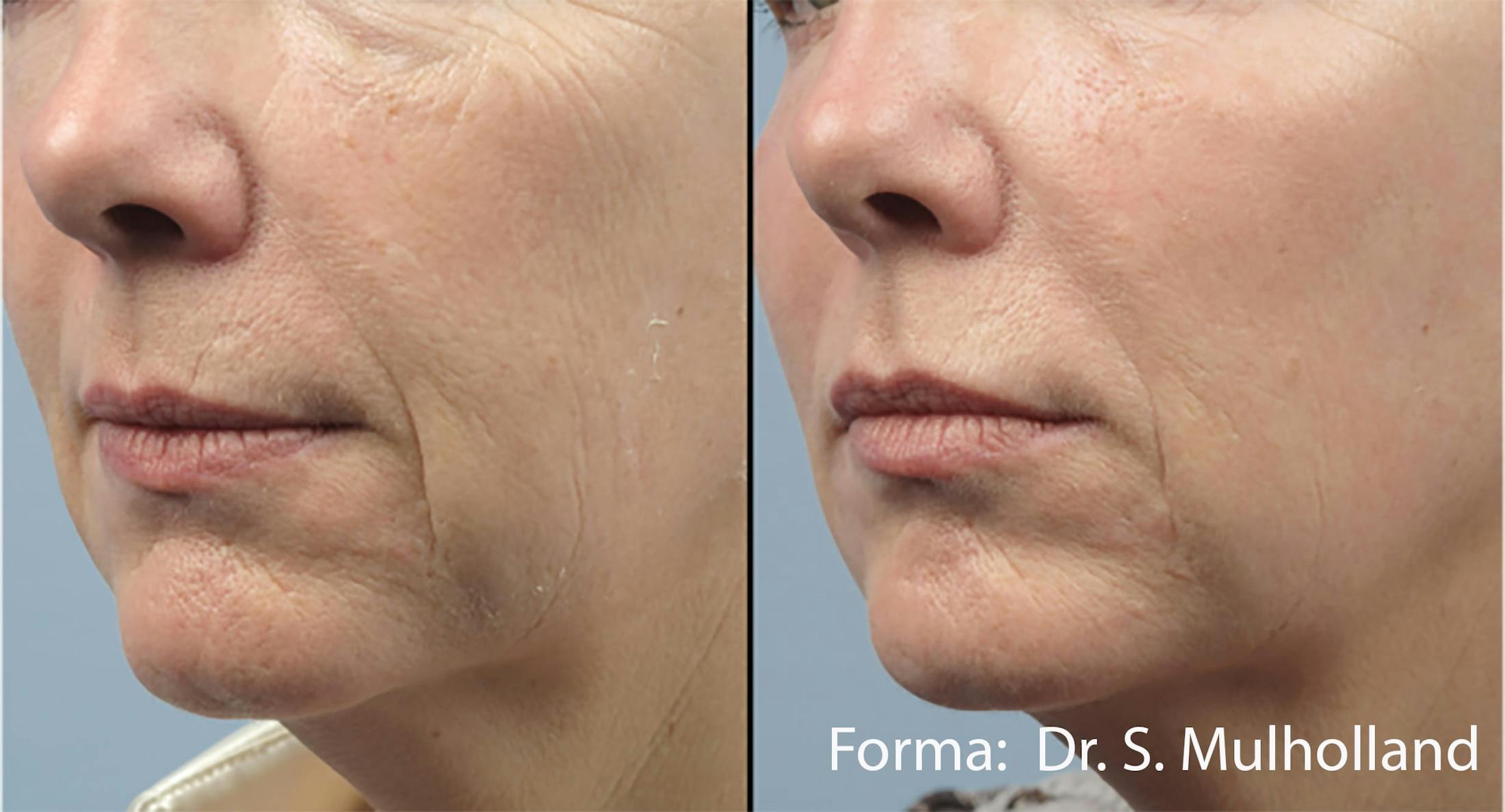 Forma Skin Tightening