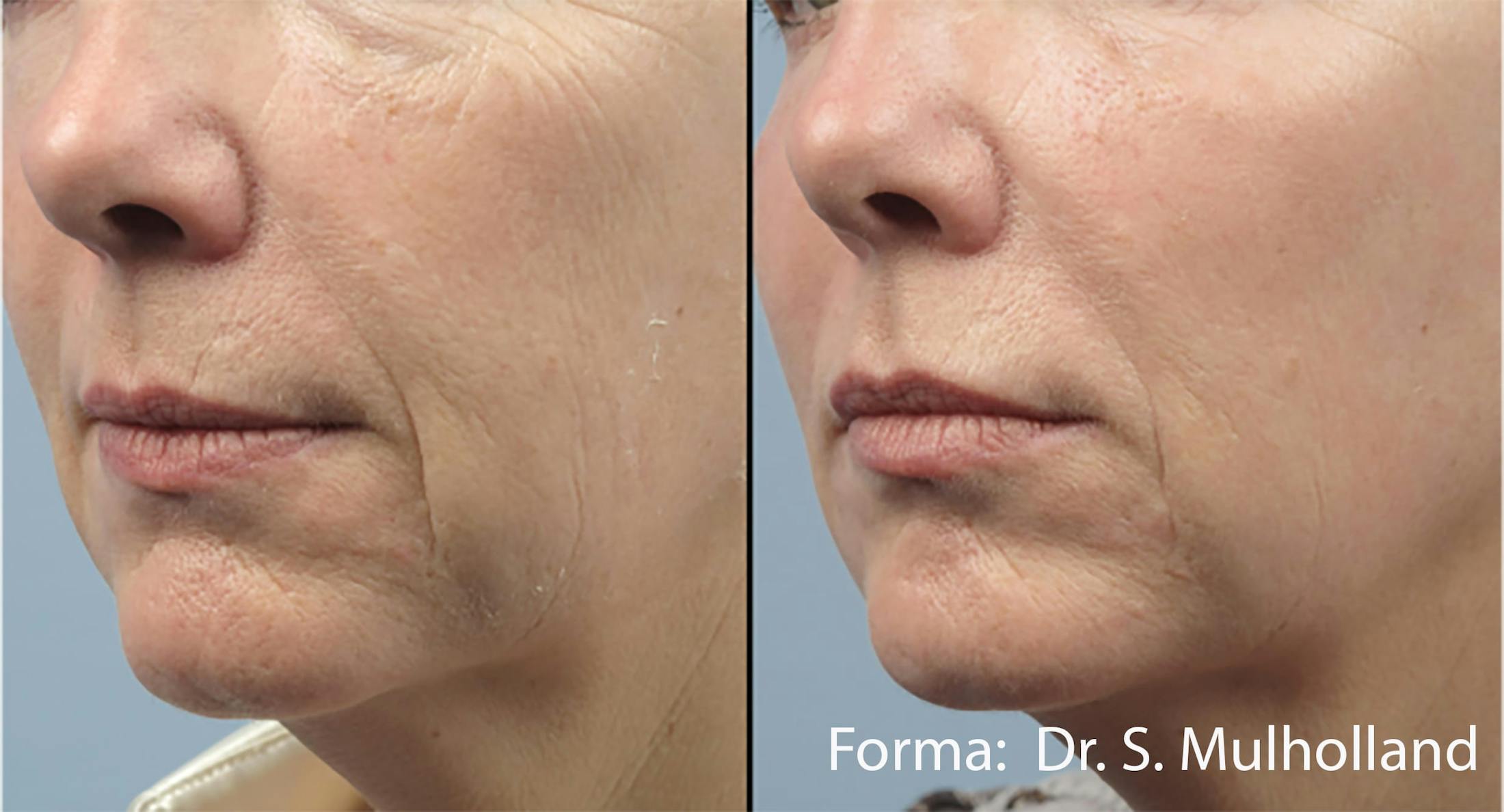 Forma Skin Tightening Before & After Gallery - Patient 107745095 - Image 1