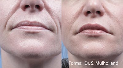 Forma Skin Tightening Before & After Gallery - Patient 107745096 - Image 1