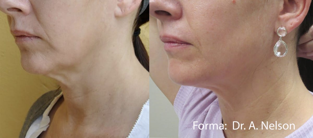 Forma Skin Tightening Before & After Gallery - Patient 107745097 - Image 1