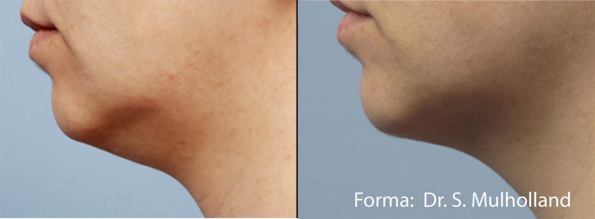 Forma Skin Tightening Before & After Gallery - Patient 107745098 - Image 1