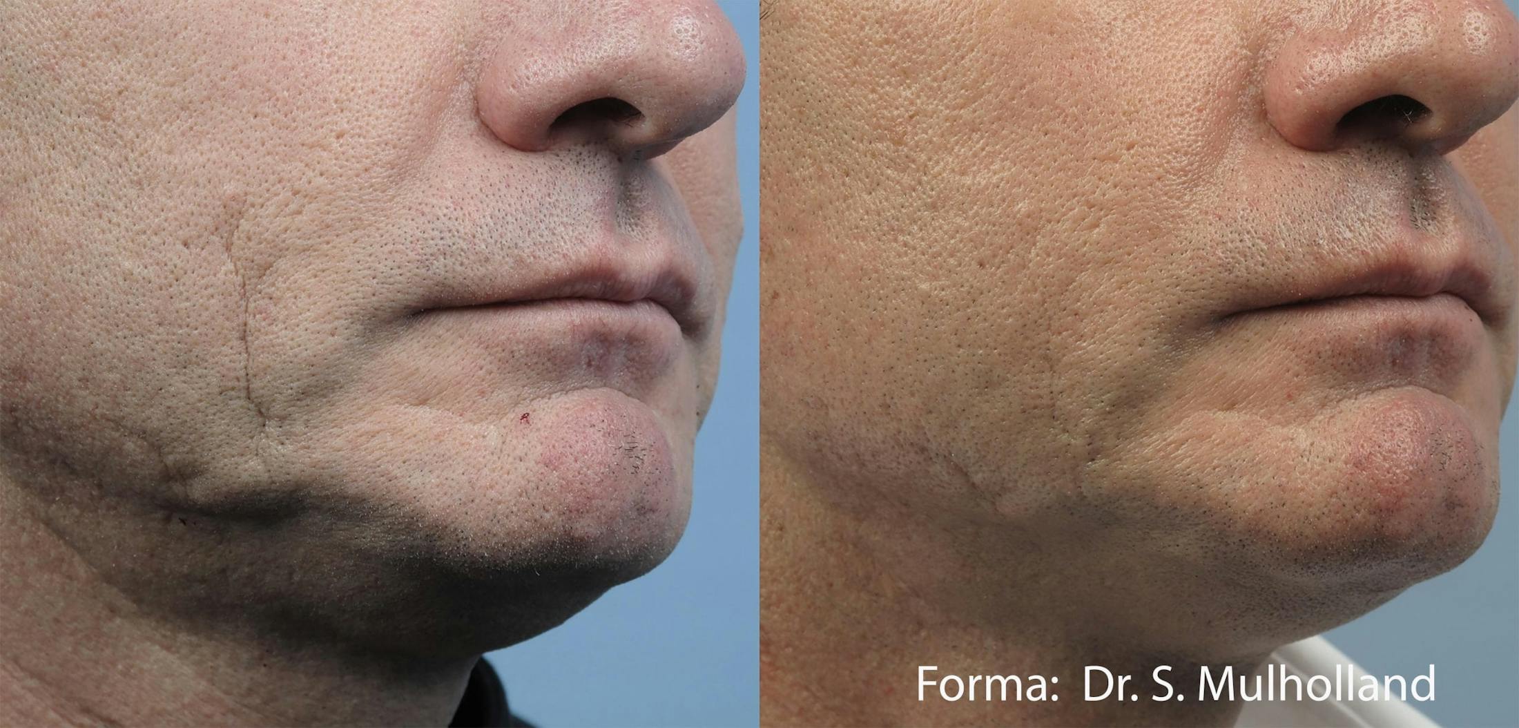 Forma Skin Tightening Before & After Gallery - Patient 107745099 - Image 1