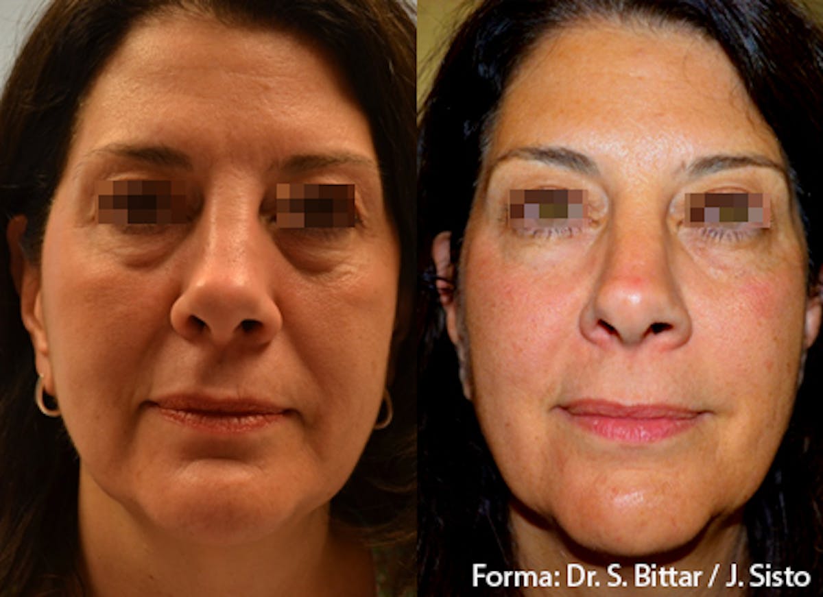 Forma Skin Tightening Before & After Gallery - Patient 107745100 - Image 1