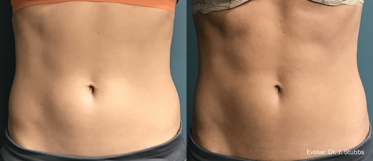 InMode Evolve Before & After Gallery - Patient 107745114 - Image 1