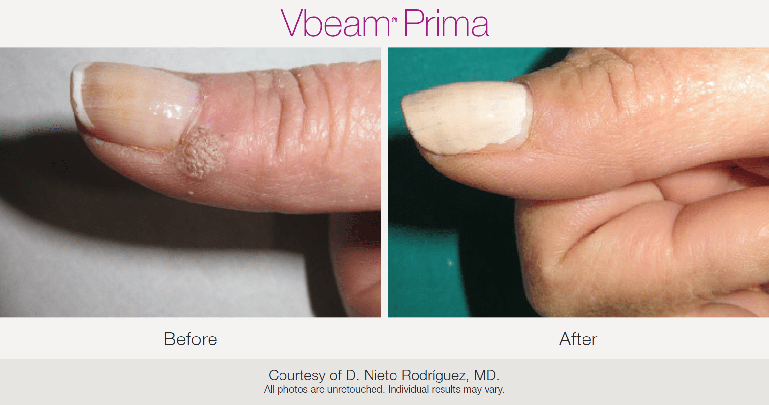 Before and after VBeam treatments