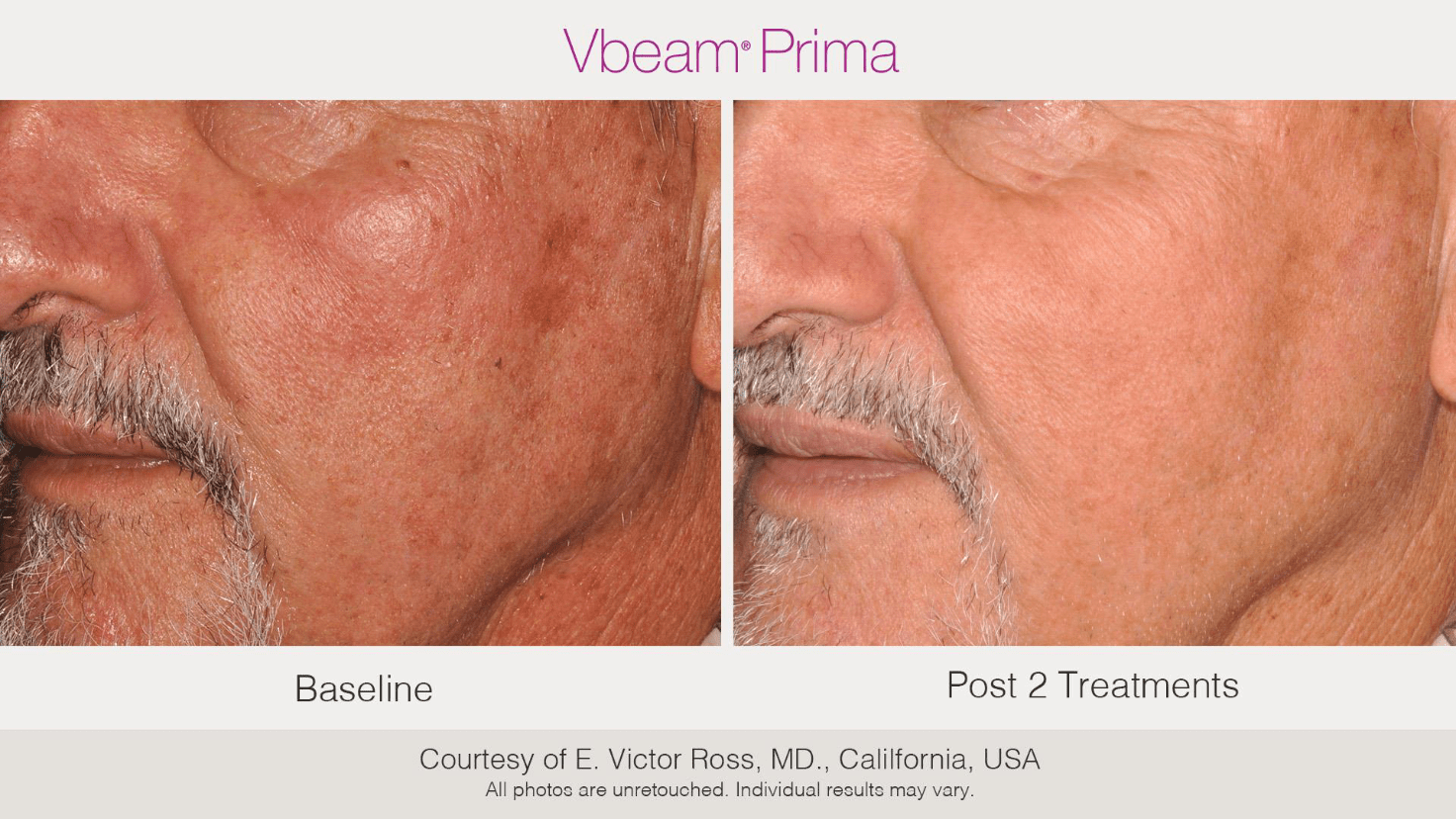 Before and after VBeam laser treatment