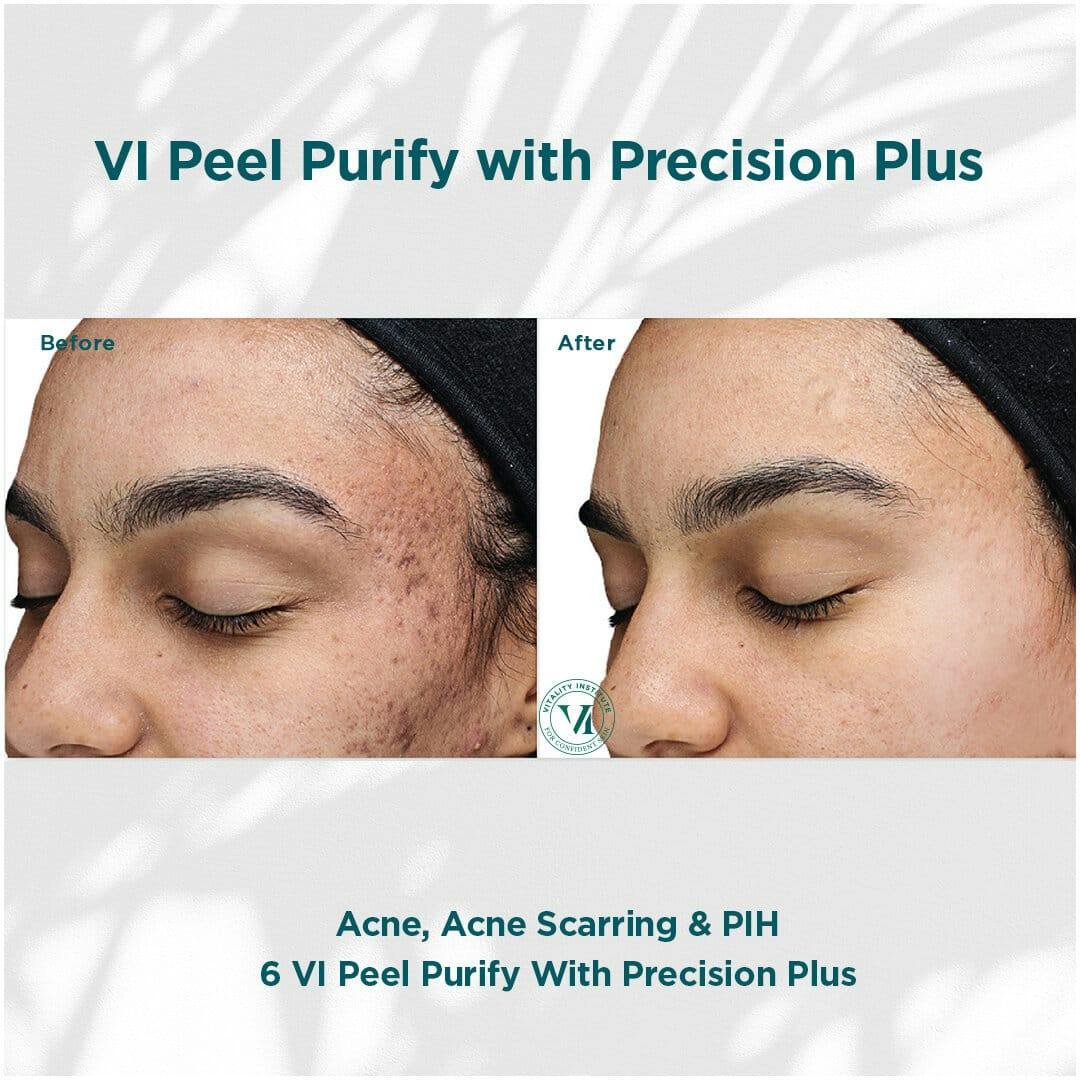 VI Peel Before & After Gallery - Patient 110865288 - Image 1