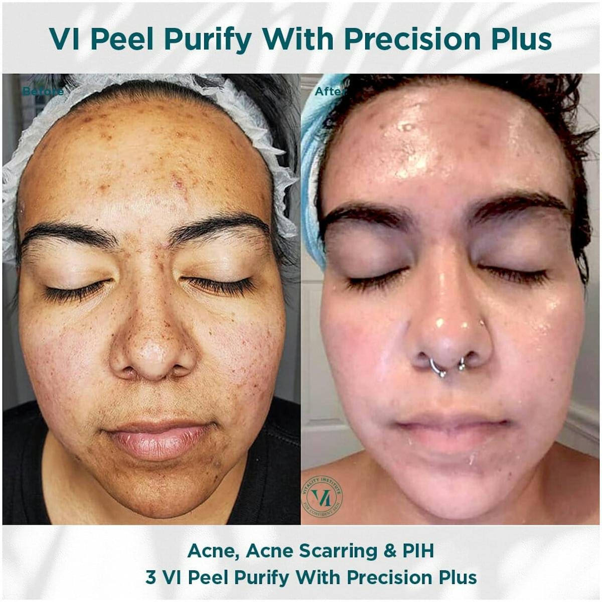 VI Peel Before & After Gallery - Patient 110865289 - Image 1