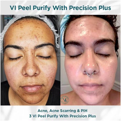 VI Peel Before & After Gallery - Patient 110865289 - Image 1