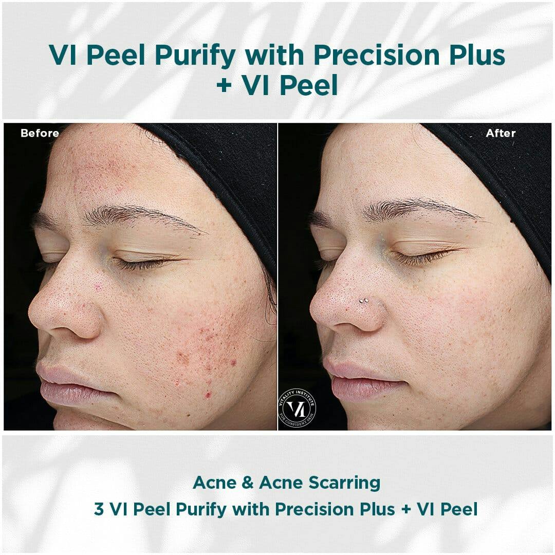 VI Peel Before & After Gallery - Patient 110865290 - Image 1