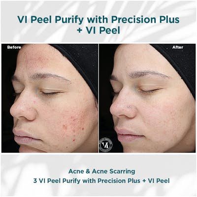 VI Peel Before & After Gallery - Patient 110865290 - Image 1