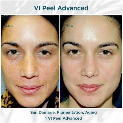 VI Peel Before & After Gallery - Patient 110865291 - Image 1