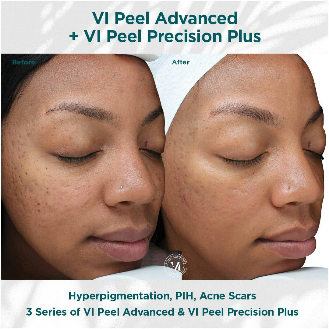 Chemical Peel