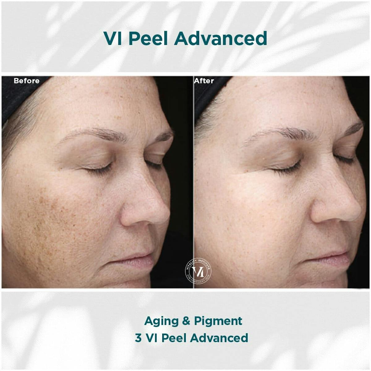 VI Peel Before & After Gallery - Patient 110865293 - Image 1