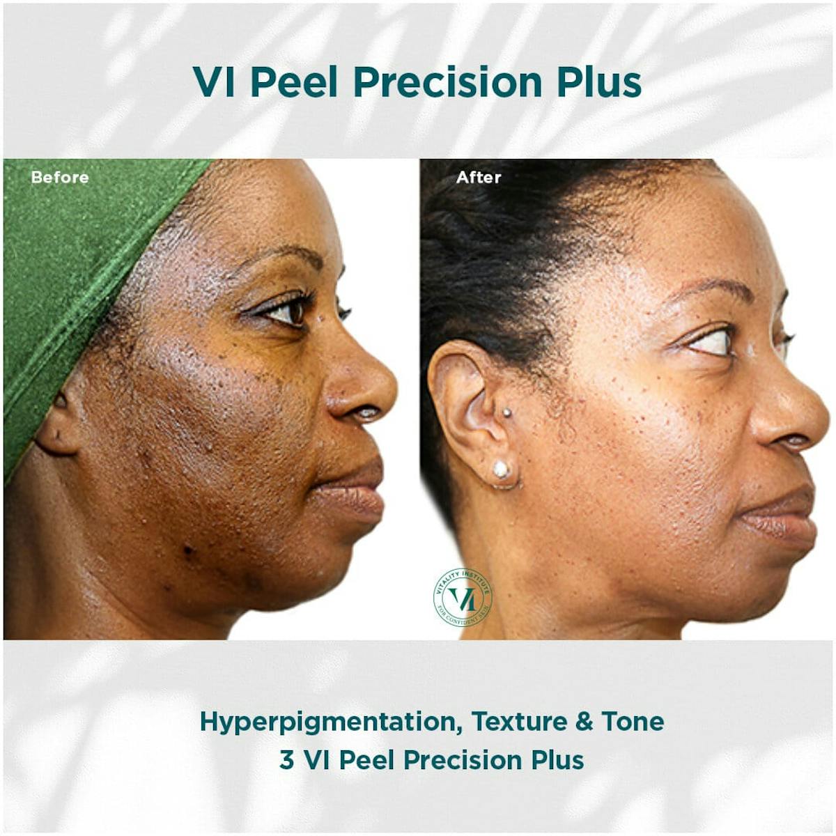 VI Peel Before & After Gallery - Patient 110865294 - Image 1