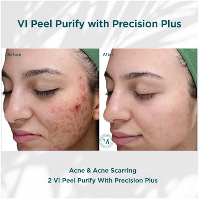 VI Peel Before & After Gallery - Patient 110865295 - Image 1