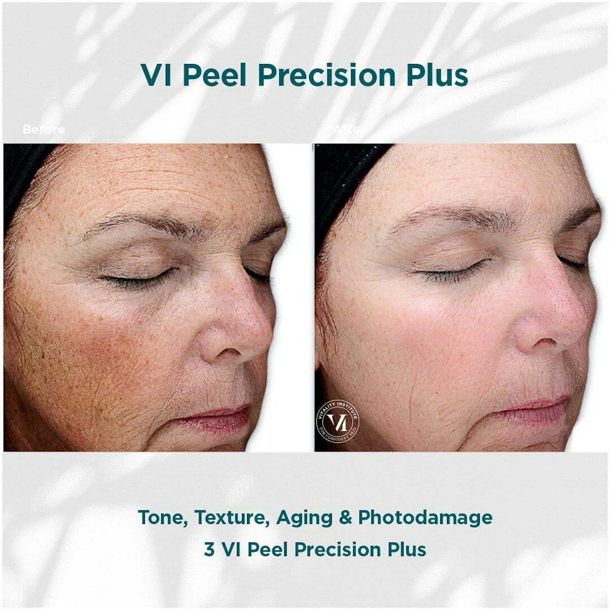 VI Peel Before & After Gallery - Patient 110865296 - Image 1