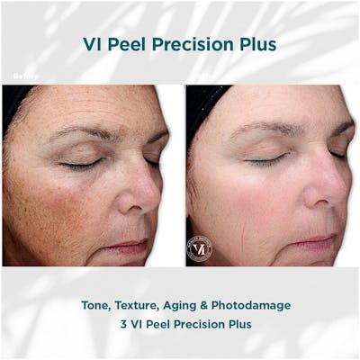 VI Peel Before & After Gallery - Patient 110865296 - Image 1