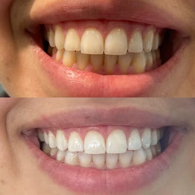 Teeth Whitening Before & After Gallery - Patient 117348961 - Image 1
