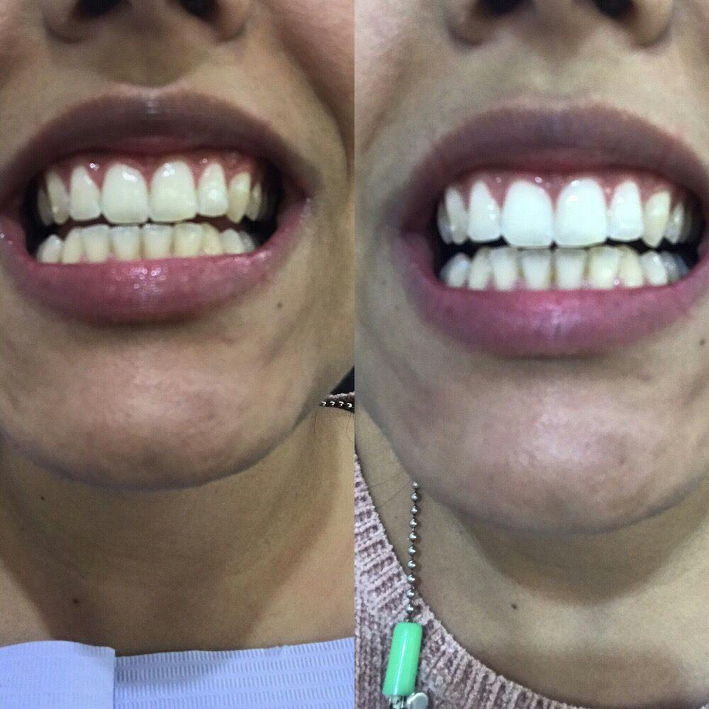 Teeth Whitening Before & After Gallery - Patient 117348962 - Image 1