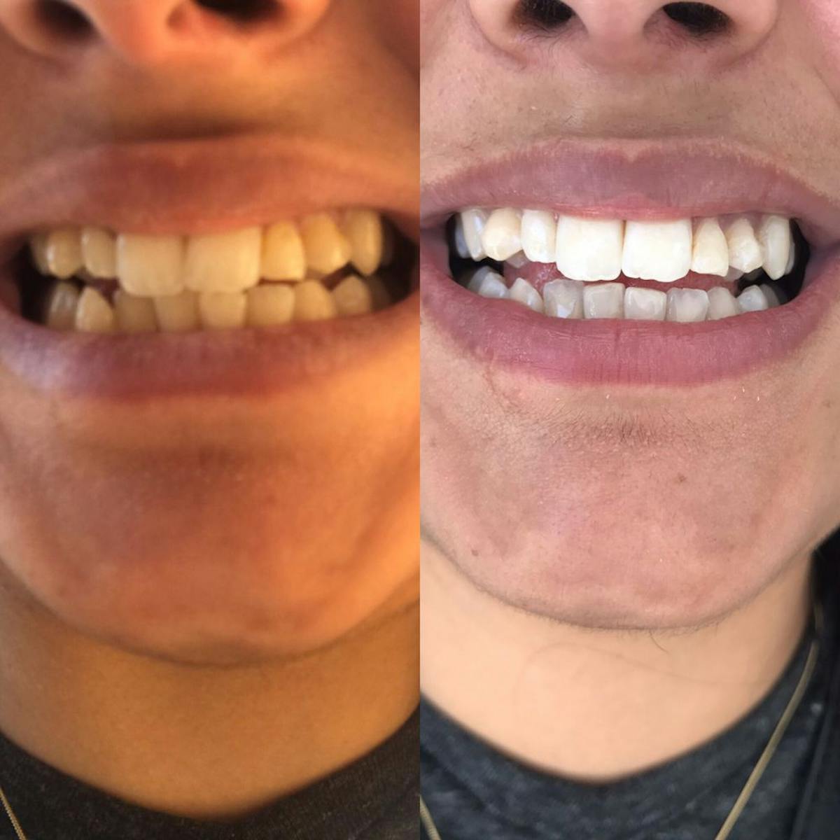 Teeth Whitening Before & After Gallery - Patient 117348963 - Image 1