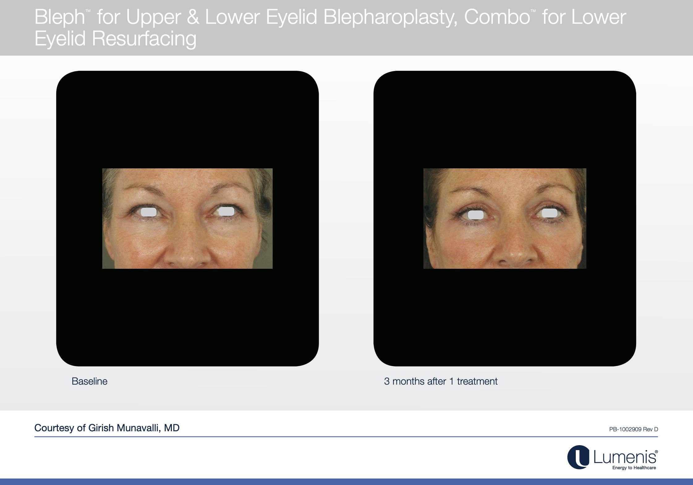 CO2 Skin Resurfacing