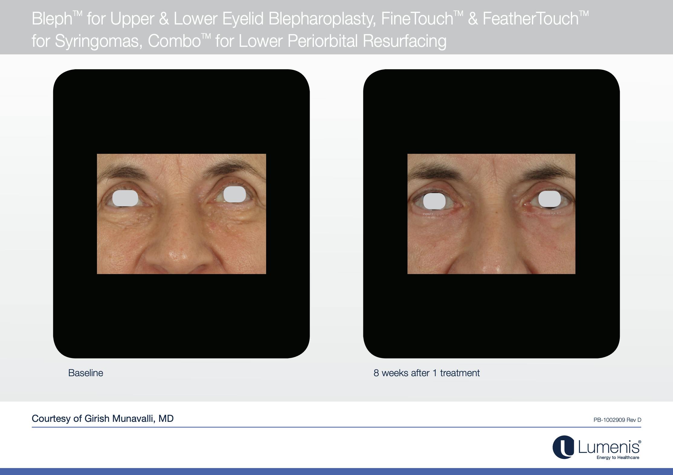 CO2 Skin Resurfacing