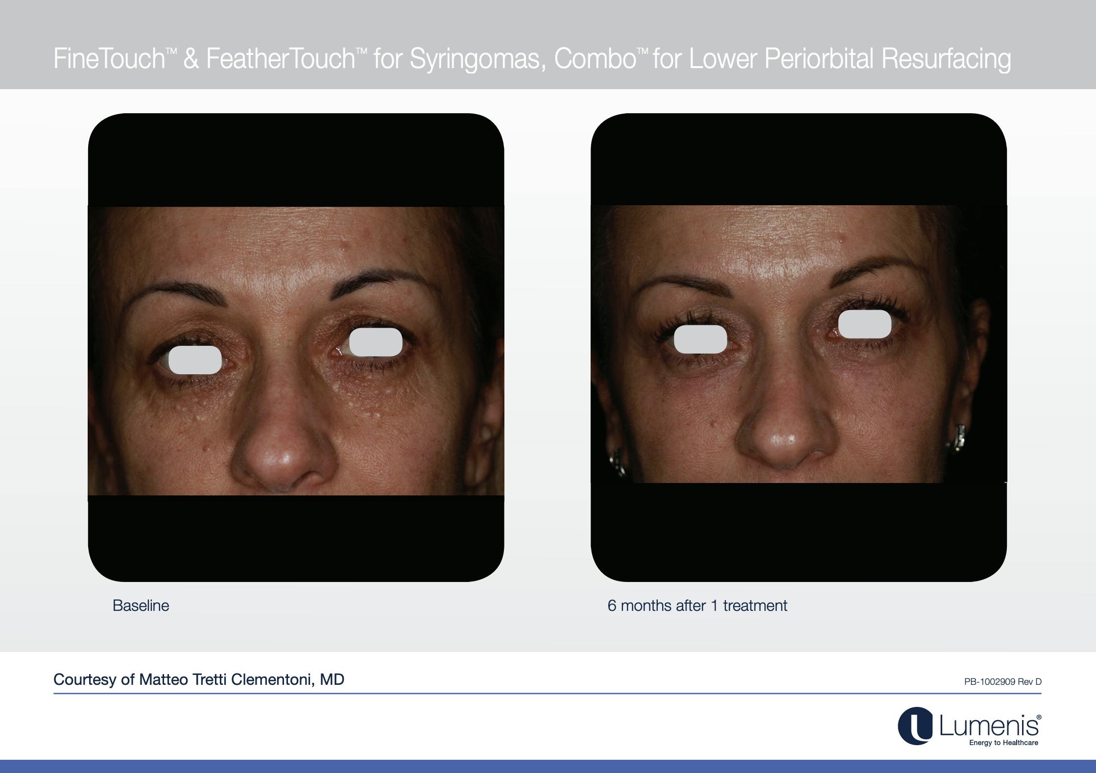 CO2 Skin Resurfacing