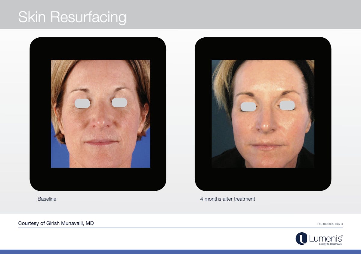 C02 Skin Resurfacing Before & After Gallery - Patient 117496927 - Image 1