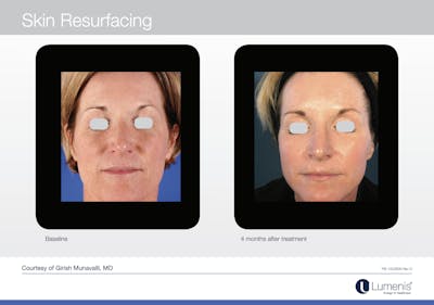 C02 Skin Resurfacing Before & After Gallery - Patient 117496927 - Image 1