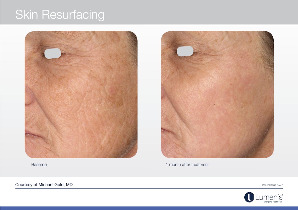 C02 Skin Resurfacing Before & After Gallery - Patient 117496928 - Image 1