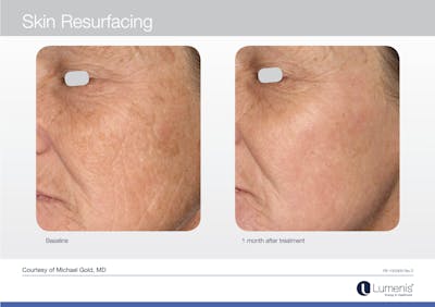 C02 Skin Resurfacing Before & After Gallery - Patient 117496928 - Image 1