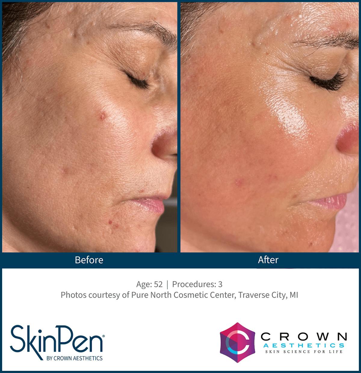 Microneedling Before & After Gallery - Patient 130106212 - Image 1