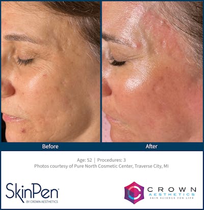 Microneedling Before & After Gallery - Patient 130106213 - Image 1