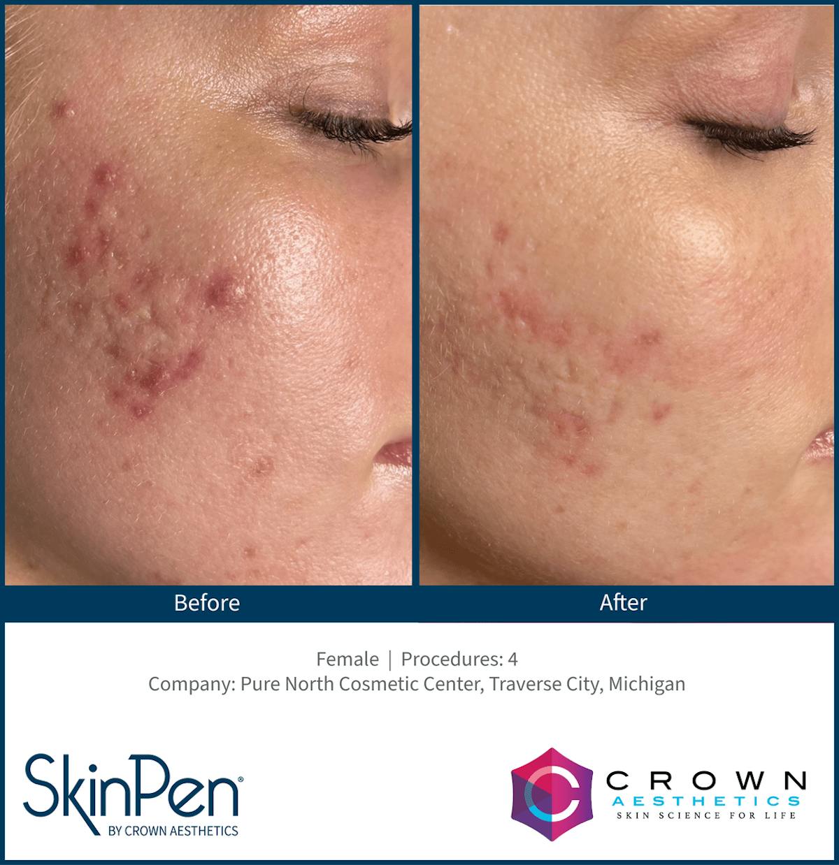 Microneedling Before & After Gallery - Patient 130106214 - Image 1