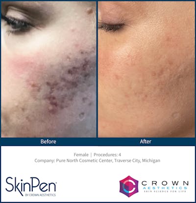 Microneedling Before & After Gallery - Patient 130106215 - Image 1