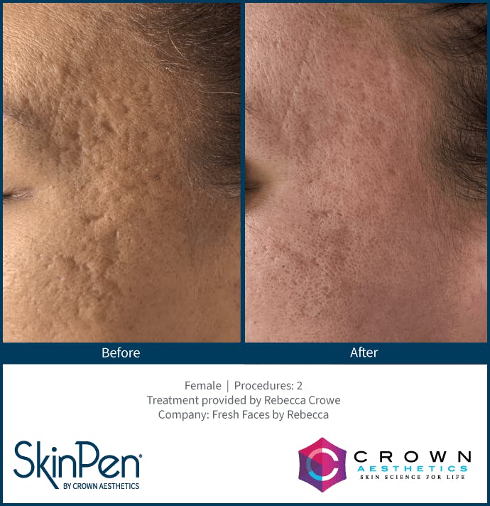 Microneedling Before & After Gallery - Patient 130106216 - Image 1