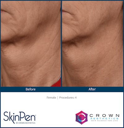 Microneedling Before & After Gallery - Patient 130106217 - Image 1