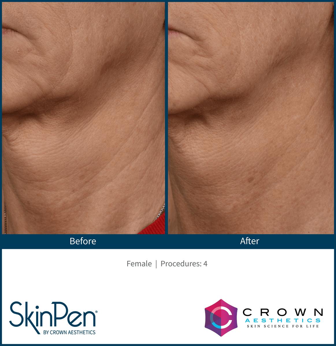 Microneedling Before & After Gallery - Patient 130106217 - Image 1