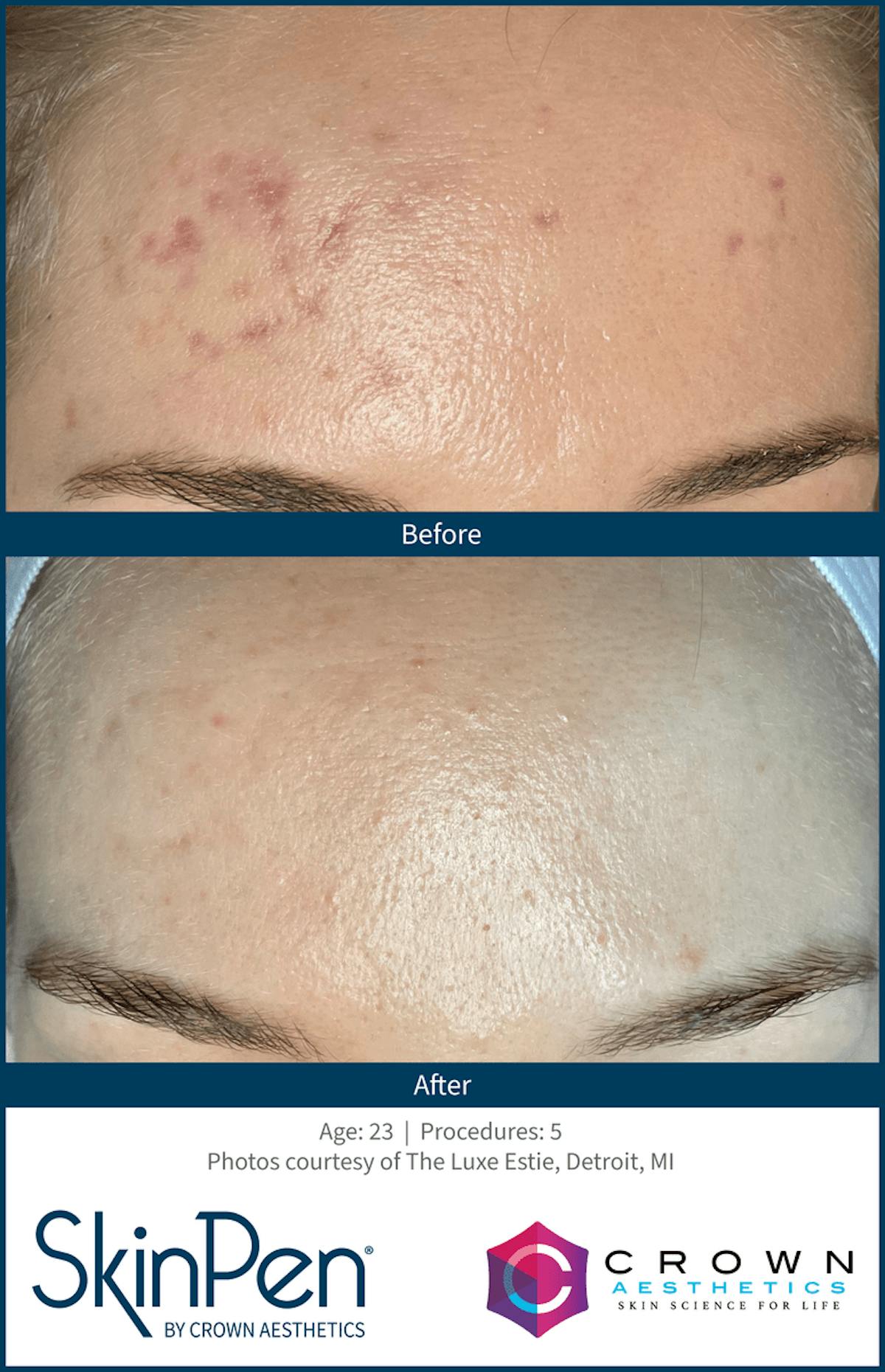 Microneedling Before & After Gallery - Patient 130106219 - Image 1