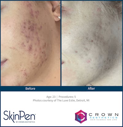 Microneedling Before & After Gallery - Patient 130106220 - Image 1