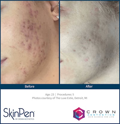 Microneedling Before & After Gallery - Patient 130106220 - Image 1