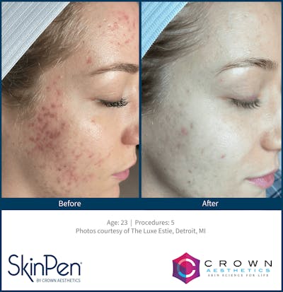 Microneedling Before & After Gallery - Patient 130106221 - Image 1