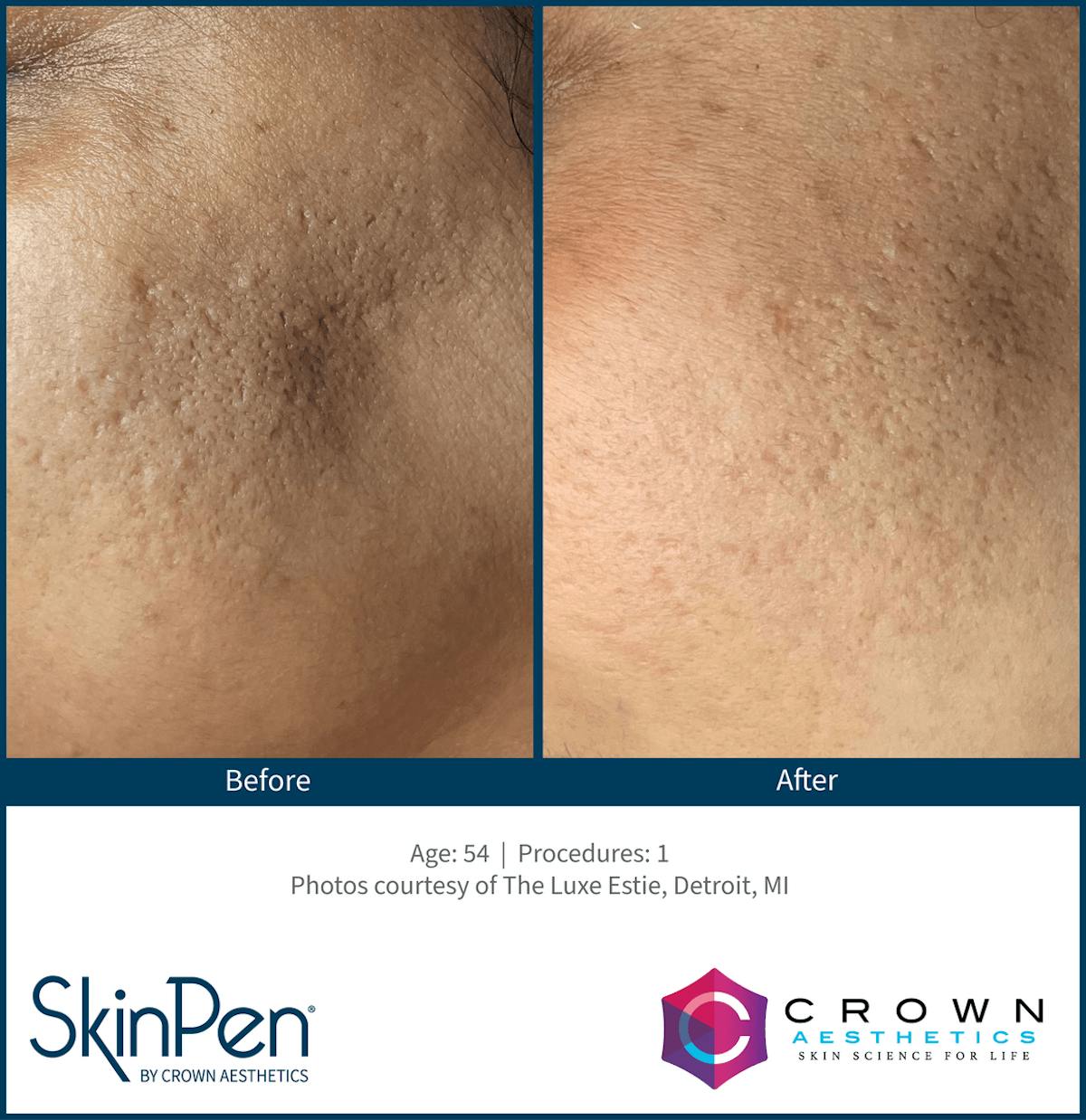 Microneedling Before & After Gallery - Patient 130106222 - Image 1