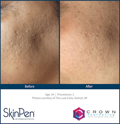 Microneedling Before & After Gallery - Patient 130106222 - Image 1